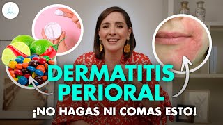 🔴 DERMATITIS PERIORAL ¡GRANITOS o IRRITACIÓN ALREDEDOR de la BOCA drapilarochoa  Dermatologa [upl. by Rachel]