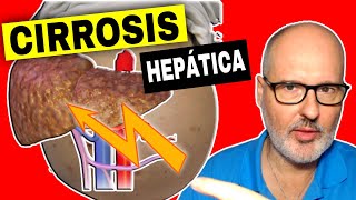 CIRROSIS HEPÁTICA 💥 Causas Síntomas y Tratamiento [upl. by Hiltan153]