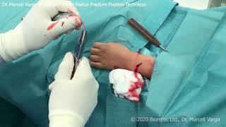 Distal radius fracture fixation with bioabsorbable implant ActivaPin™ Technique by Dr Varga [upl. by Zendah]