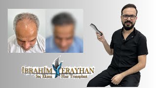 Beyaz ve Kır Saçlılarda Saç Ekimi  Hair Transplantation for White Hair [upl. by Haukom]