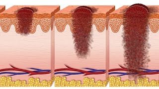 Comment définiton un ulcère de jambe [upl. by Towrey]