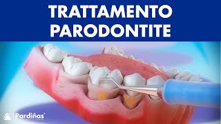 Trattamento parodontite – Curettage e sondaggio parodontale © [upl. by Nachison316]