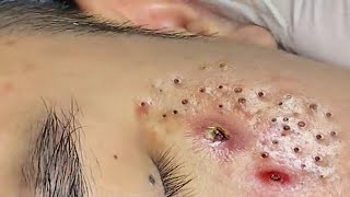 Blackhead Treatment At Loan Nguyen Spa  17 [upl. by Adlare]