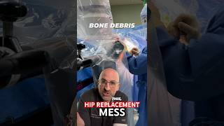 Bone Shaving Mess in Hip Replacement Surgery shorts [upl. by Hobbs]