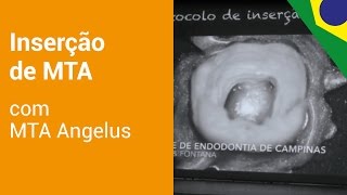 MTA Angelus  Protocolo de inserção do MTA [upl. by Aket]