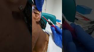 Crazy earwax removal Ear cleaning [upl. by Atiuqad]