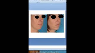 Chin Augmentation in 15 Minutes [upl. by Amaris692]