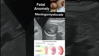 Fetal Meningomyelocele Insights into Diagnosis and Care case fetalanomaly shorts DrSaimakhan [upl. by Klusek]