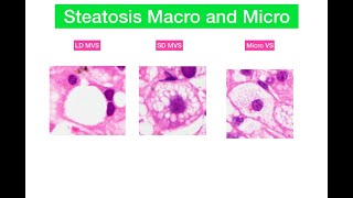 Macro and microvesicular steatosis in liver [upl. by Siraf380]