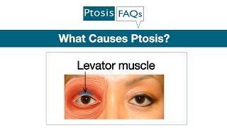 What Causes Ptosis Explained by Oculoplastic Surgeon Dr Amiya Prasad [upl. by Raseac748]