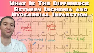 Myocardial Infarction vs Ischemia Whats the Difference [upl. by Attehcnoc448]