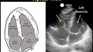 How to Cardiac Ultrasound  Apical View Case Study [upl. by Ennasil]