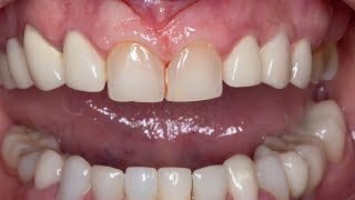 Gum retraction  preparation of Teeth for veneers  preparation of Teeth for crowns [upl. by Chancellor]