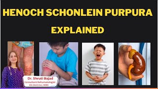 HenochSchonlein Purpura  IGA Vasculitis  Dr Shruti Bajad vasculitis arthritis [upl. by Asilla]