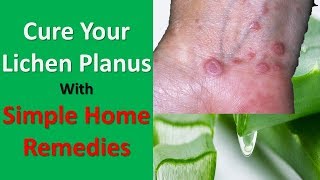 Cure Your Lichen Planus With These Simple Home Remedies [upl. by Tedra]