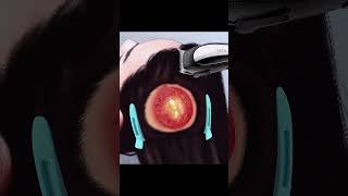 ASMR Ingrown Hair Treatment Giant Infected Ingrown Hair shrots asmr ingrownhair relax [upl. by Akaenahs709]