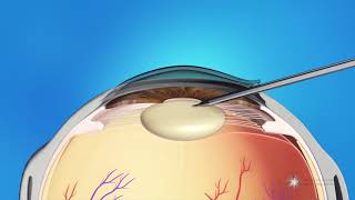 Phacoemulsification Cataract Surgery [upl. by Adlai]