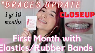 Braces CLOSEUP Video  UPDATE of first month with ELASTICSRUBBER BANDS [upl. by Hewie360]