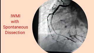 Heart attackIWMI with dissection of RCA Stenting of RCA [upl. by Broome868]