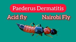 Paederus Dermatitis Nairobi fly Cause Symptoms Treatment of Acid Fly infection [upl. by Uri171]