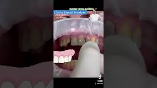 Fundas Unitarias de Zirconio Clínica Dental Sonrizas [upl. by Rajiv]