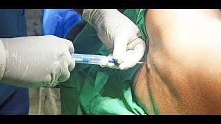 Epidural Anaesthesia  2  techniques  DrSParthasarathy MDDNB PhD [upl. by Assetak709]