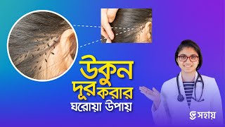 মাত্র ১ দিনেই উকুন দূর করার উপায় — ডা তাসনিম জারা চিকিৎসক ইংল্যান্ড [upl. by Rodl]