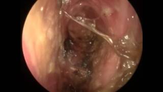 Chronic rhinosinusitis Empty nose syndrome [upl. by Strohbehn]