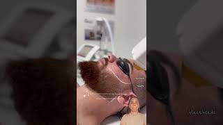 laser hair removal laser hair removal at home laser hair removal on beard [upl. by Ahsener272]