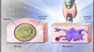 CLD Inc  Benign Versus Malignant [upl. by Miltie]