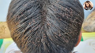 Chill video to watch head lice removal 55 [upl. by Ecertak]