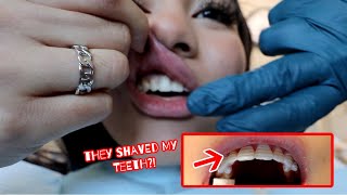 GETTING MY TEMPORARY VENEERS VLOGGED EVERYTHING it hurt [upl. by Ttegdirb]