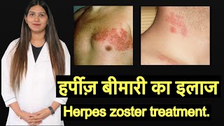 Herpes zoster Shingles treatment in Hindi  हर्पीज़ का इलाज [upl. by Tenom]