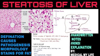 Steatosis Of Liver  Fatty Liver  Pathology [upl. by Happ]