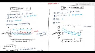 Conductive and Sensorineural Hearing Loss Deafness for USMLE [upl. by Zola436]