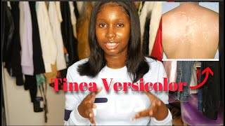 ITS NOT ECZEMA Treating my Tinea Versicolor  Black Skin Friendly [upl. by Asilrak]