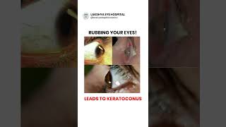 Stop Rubbing Your Eyes Protect Your Vision from Keratoconus [upl. by Llatsyrk657]