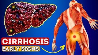 12 Early Signs of Liver CIRRHOSIS  LIVER is DYING [upl. by Gilead120]