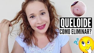 COMO ELIMINAR QUELOIDE DO PIERCING  DUAS DICAS  POR LEYA ARAGÃO [upl. by Sekyere]