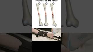 Broken Femur Symptoms and Causes  Diagnosis  Treatment  Prevention disease healthcare healthy [upl. by Arded]