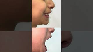 Kids jaw correction children posture correction early orthodontic treatment in the childhood ￼ [upl. by Nerraj824]