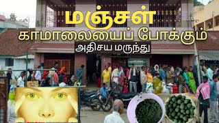 Jaundice Treatment  மஞ்சள் காமாலை மருந்து  walajapet jaundice medicine  Manjal kaamalai Marundhu [upl. by Yroggerg]