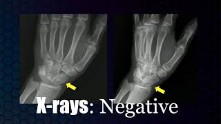 Imaging evaluation of upper extremity injury [upl. by Airpal959]