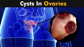 Ovarian Cysts  Types Causes and Symptoms UrduHindi [upl. by Aihtnis]