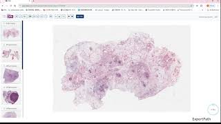 inflammatory myofibroblastic tumorIMT desmoid fibromatosis GIPATH [upl. by Wyler109]