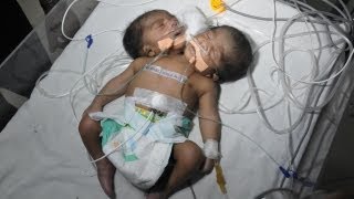 Two Headed Baby Conjoined Twin Boys In India [upl. by Luckett]