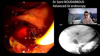 ERCP for acute cholangitis  hydatic cyst [upl. by Lirbij]