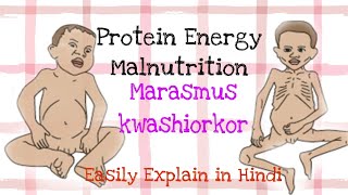 Marasmus and kwashiorkor Easy explanation in Hindi biomedical mbbs nursing [upl. by Telfore]