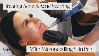 This Is Microneedling for Acne Scarring 🎯 [upl. by Searby]