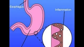 What is Gastritis [upl. by Helbona]